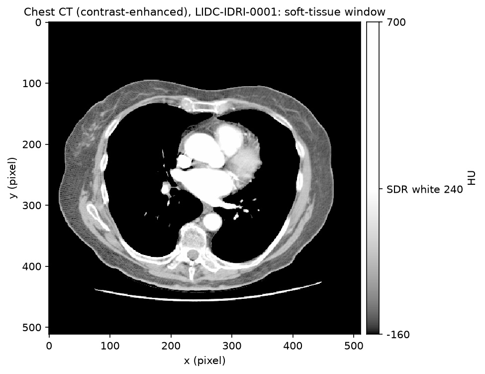 Contrast-enhanced chest CT slice in a soft-tissue window; the heart chambers, great vessels and bone are white in SDR.